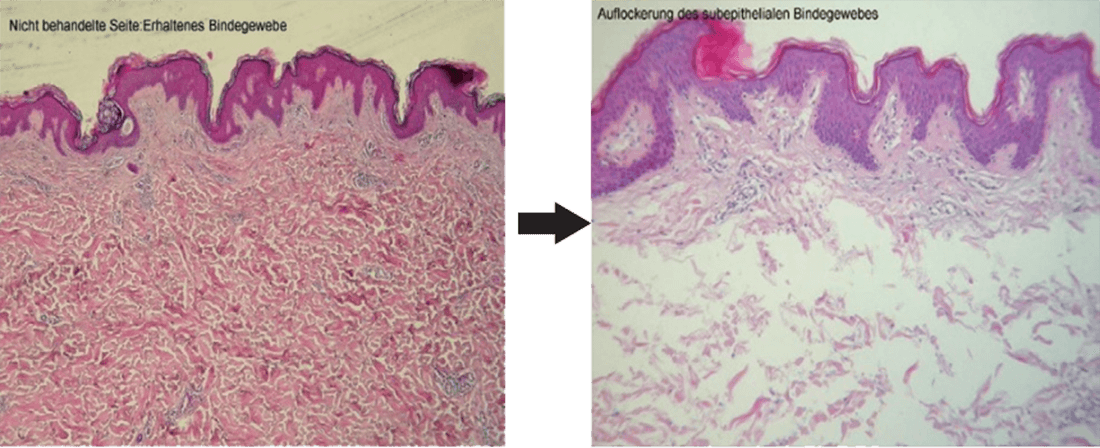 皮膚組織を緩める「Loosening effect」によるECM再構築(コラーゲン/エラスチン/GAGs)