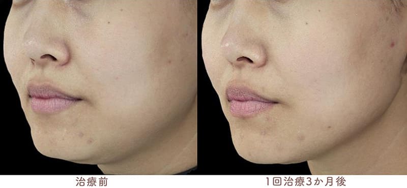30代女性、Vline、顎下のボリュームダウン