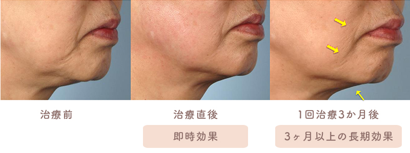 60代女性、Vline、顎下のたるみと質感