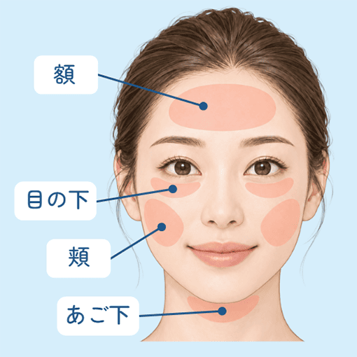  エムフェイスの治療範囲